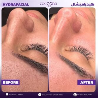 hydra facial